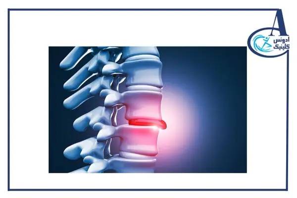 دیسک کمر چیست - ادونس کلینیک